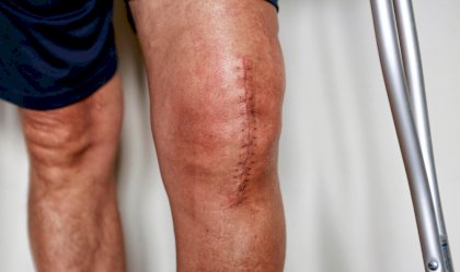 Knee-Surgery.jpg