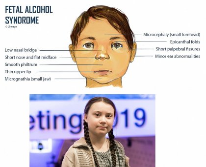 greta fetal alcohol syndrome.jpg